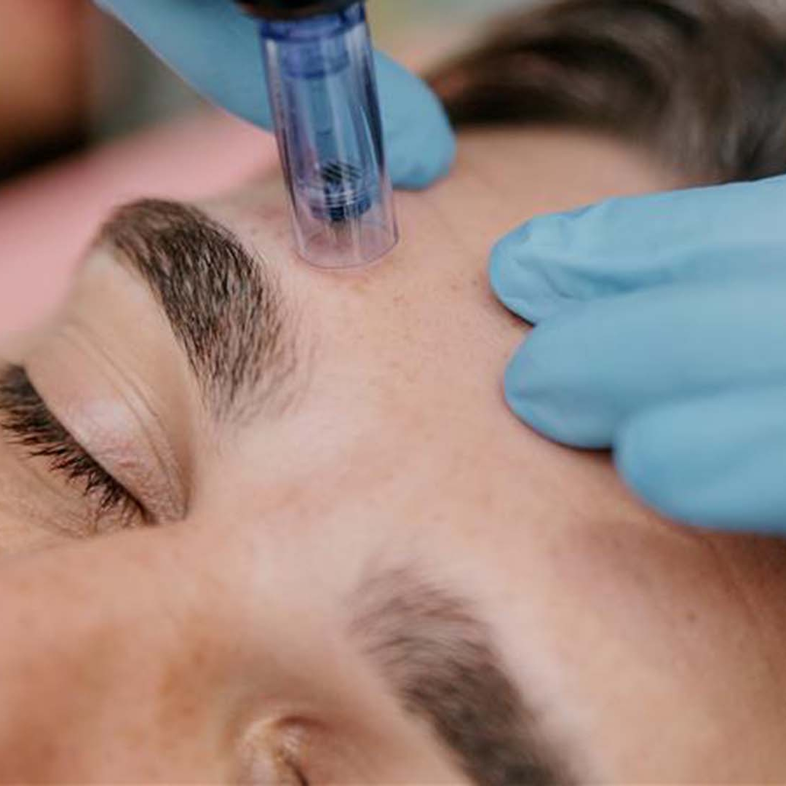Microneedling Ingolstadt, mydays Erlebnisgutschein, als PDF ausdruckbar oder Versand mit Geschenkverpackung