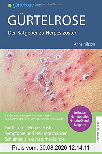 Gürtelrose Ratgeber