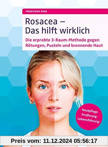 Rosacea - Das hilft wirklich: Die erprobte 3-Raum-Methode gegen Rötungen, Pusteln und brennende Haut, Hautpflege, Ernähr